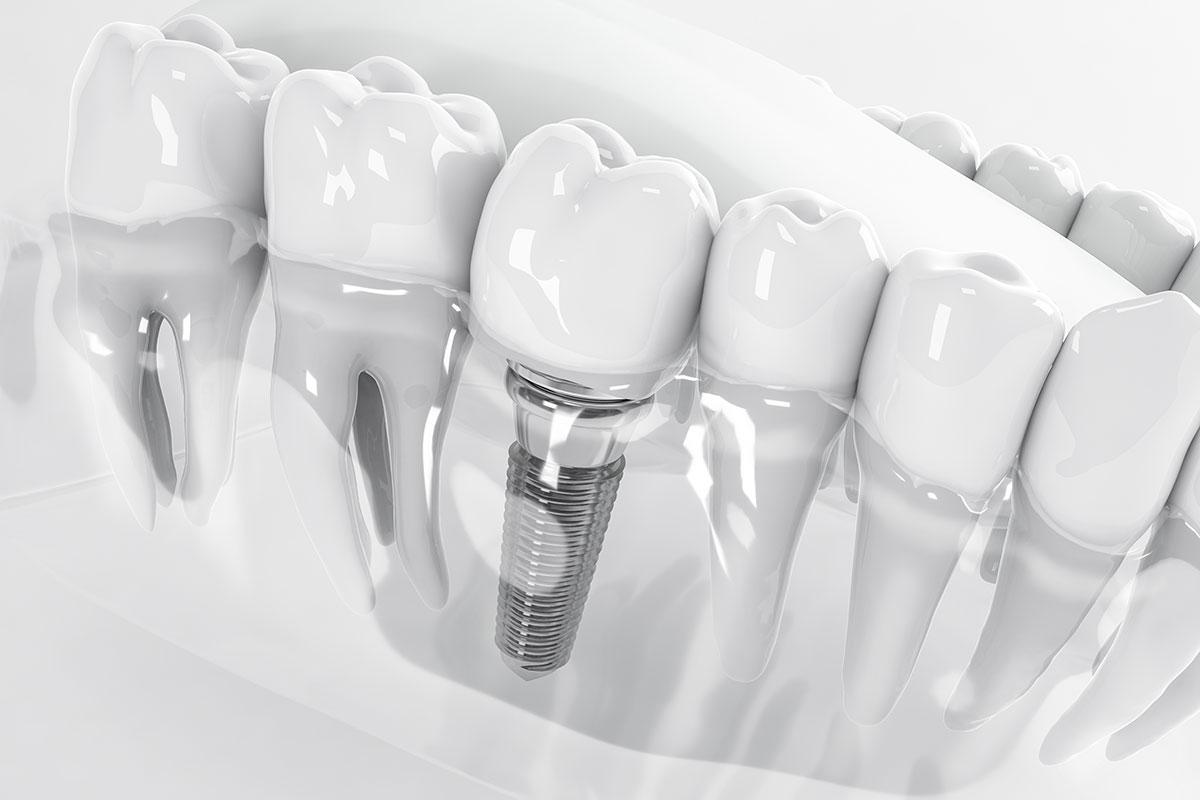 Dental implant restorations in East Orlando, Alafaya Trail