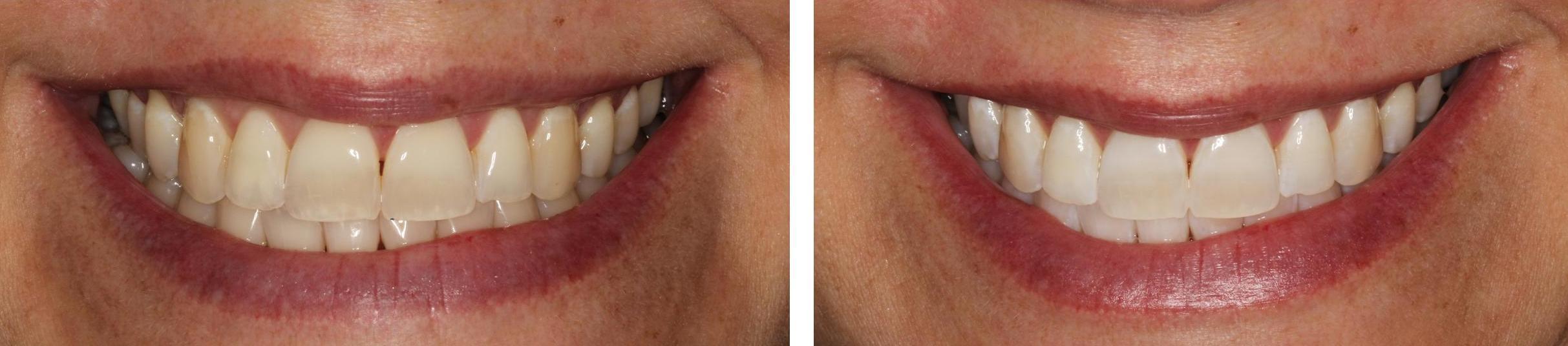 actual patient at Maple Dentistry in Orlando FL before & after Zoom! whitening